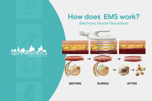 EMS treatment for post pregnancy weight loss treatment Huntingdon