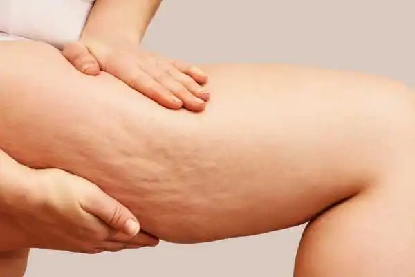 Image of woman showing leg with cellulite Huntingdon