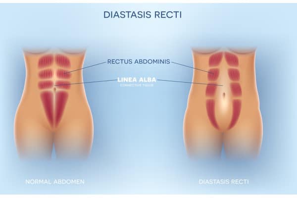 What Non-Surgical Options Are Available for Diastasis Recti Huntingdon?