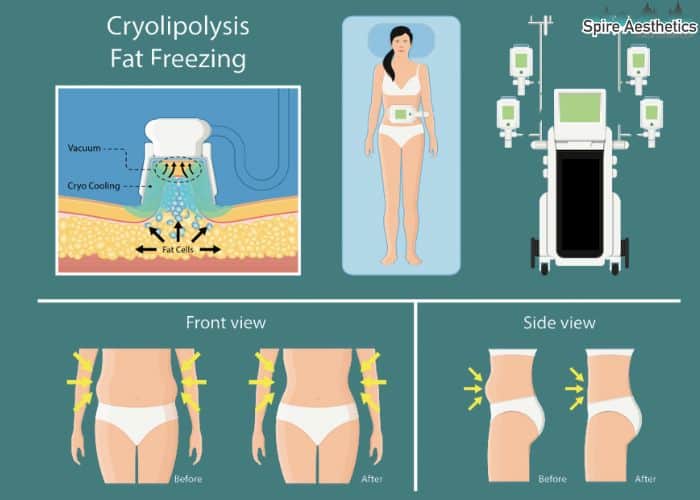 Image of diet and fat freezing combined for best results for Spire Aesthetics Huntingdon
