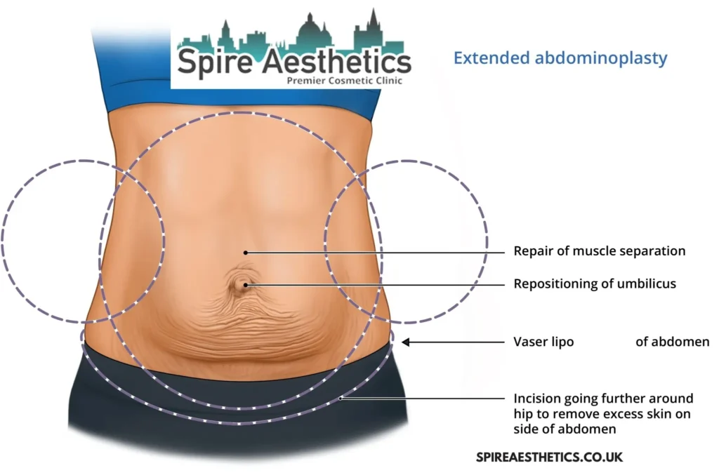 Understanding Loose Skin After Gastric Band Huntingdon Surgery and HIFU Treatment