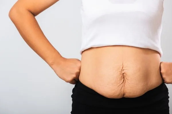 Image of a woman's stomach after weight loss with sagging skin following a gastric band Huntingdon