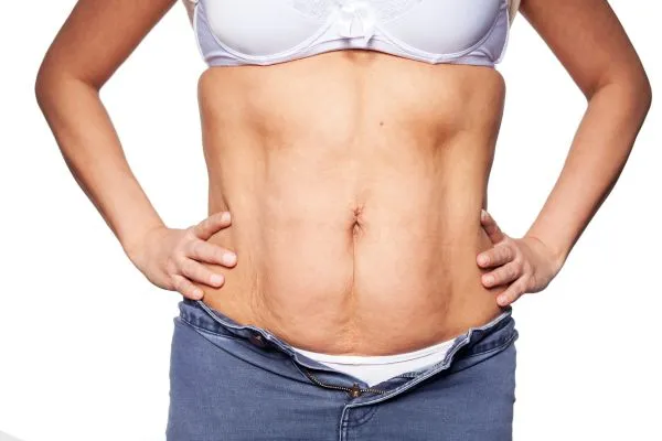 sagging skin on woman's stomach after weight loss injections Huntingdon