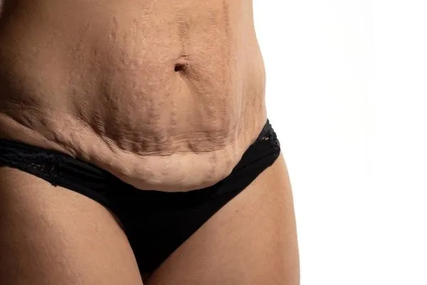 Image of womans stomach after weight loss injections Huntingdon showing saggy skin