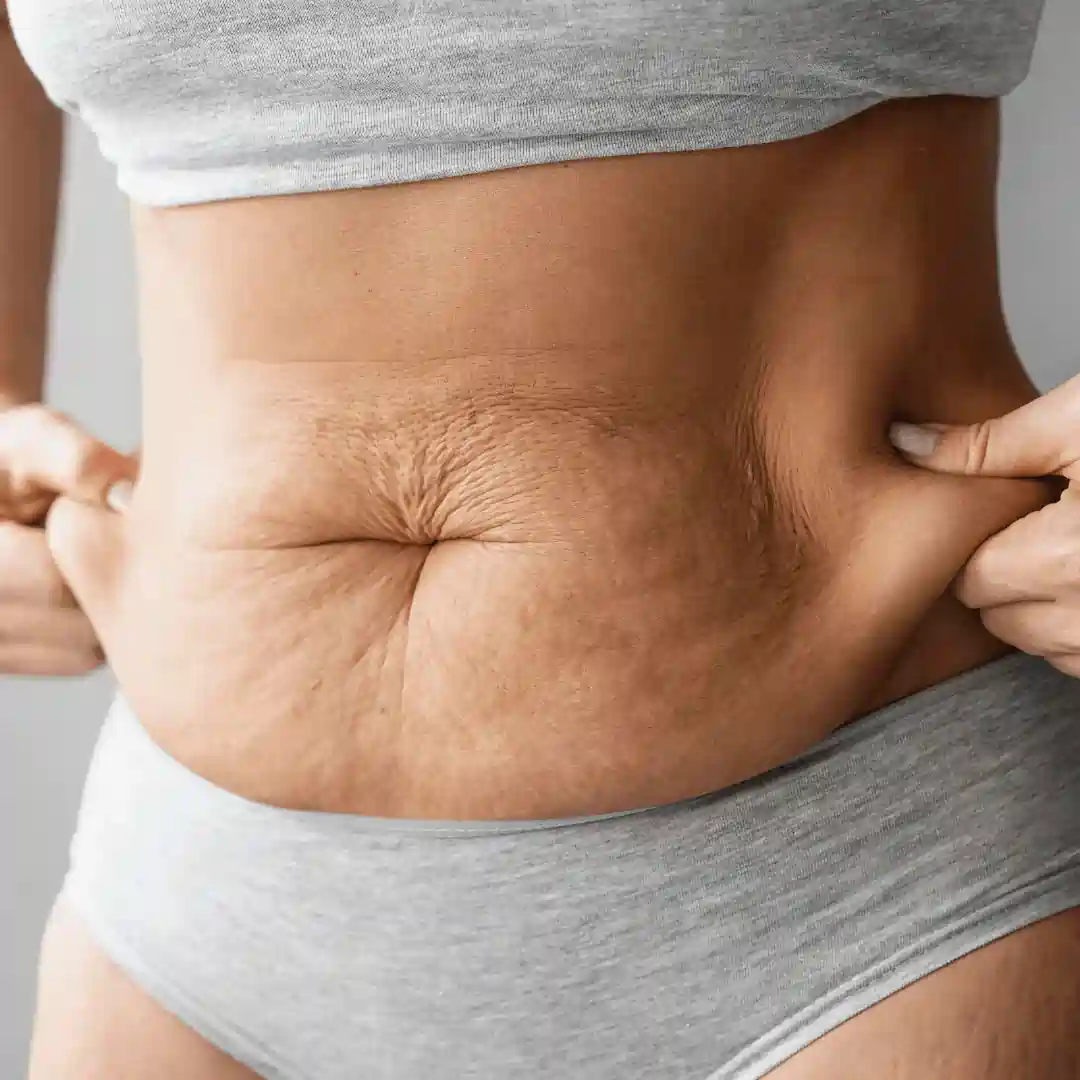 Is It Normal to Have Loose Skin After Pregnancy Huntingdon?