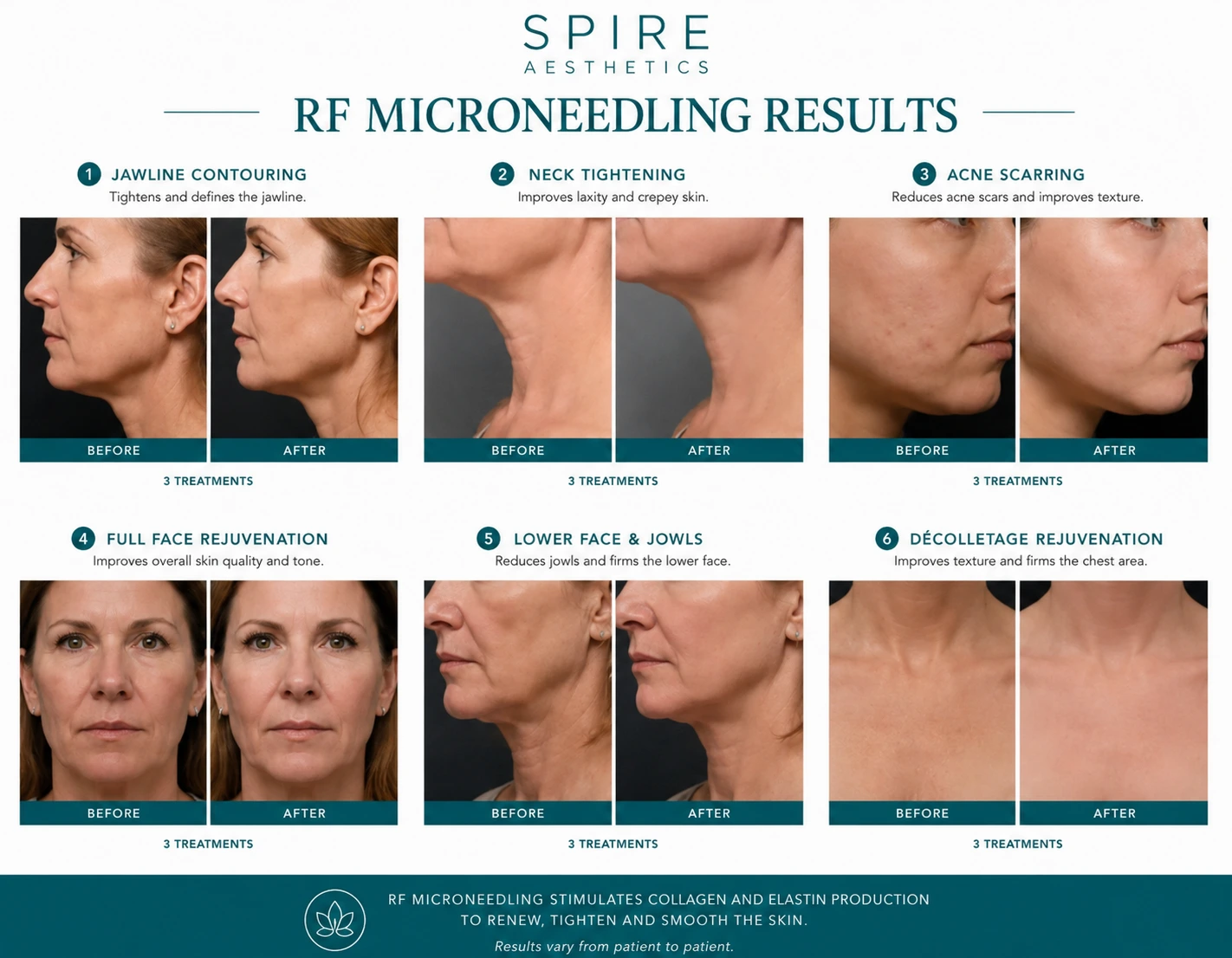 RF Microneedling Skin tightening Huntingdon results