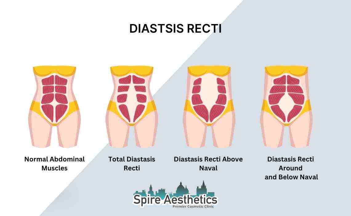 Is Non-Surgical Diastasis Recti Treatment Right for You? Common Concerns Answered Huntingdon